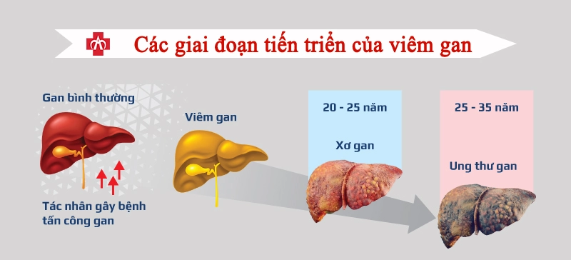 Silybin | Hoạt chất thần kỳ cho gan khỏe mạnh 5 viem-gan-sieu-vi